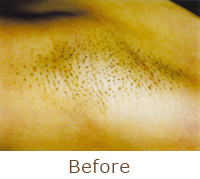 フラッシュ脱毛